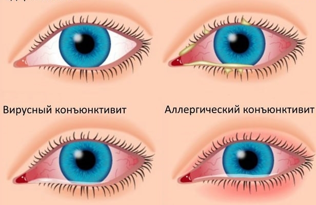 Роспотребнадзор: конъюнктивит- воспаление слизистой оболочки век и глазного яблока
